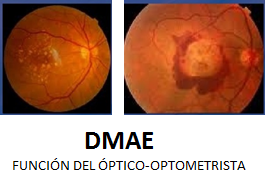 DMAE Función del Óptico-Optometrista Imágenes de Degeneración macular asociada a la edad